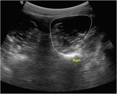 Lumbar multifidus characteristics and body composition in university level athletes